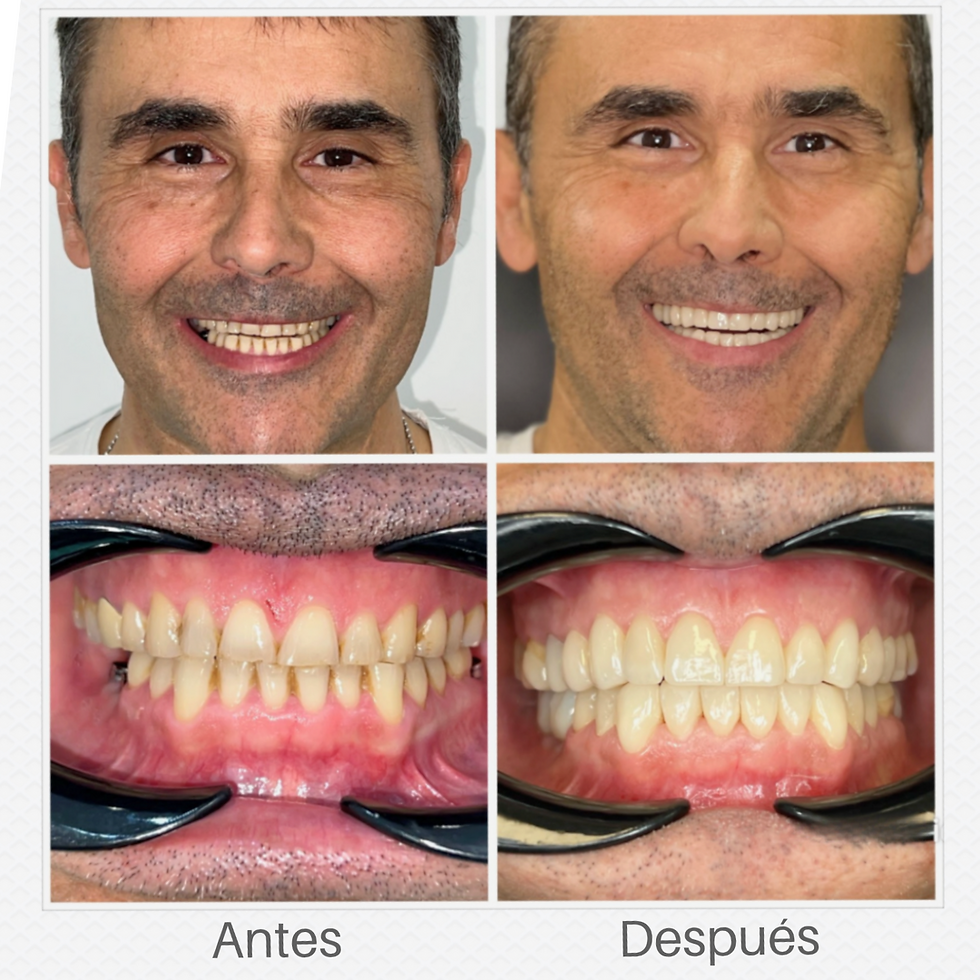 Caso Clínico realizado por el Dr. David Ospina Mateos, vemos un hombre sonriendo, mostrando el antes y el después de su tratamiento de carillas dentáles