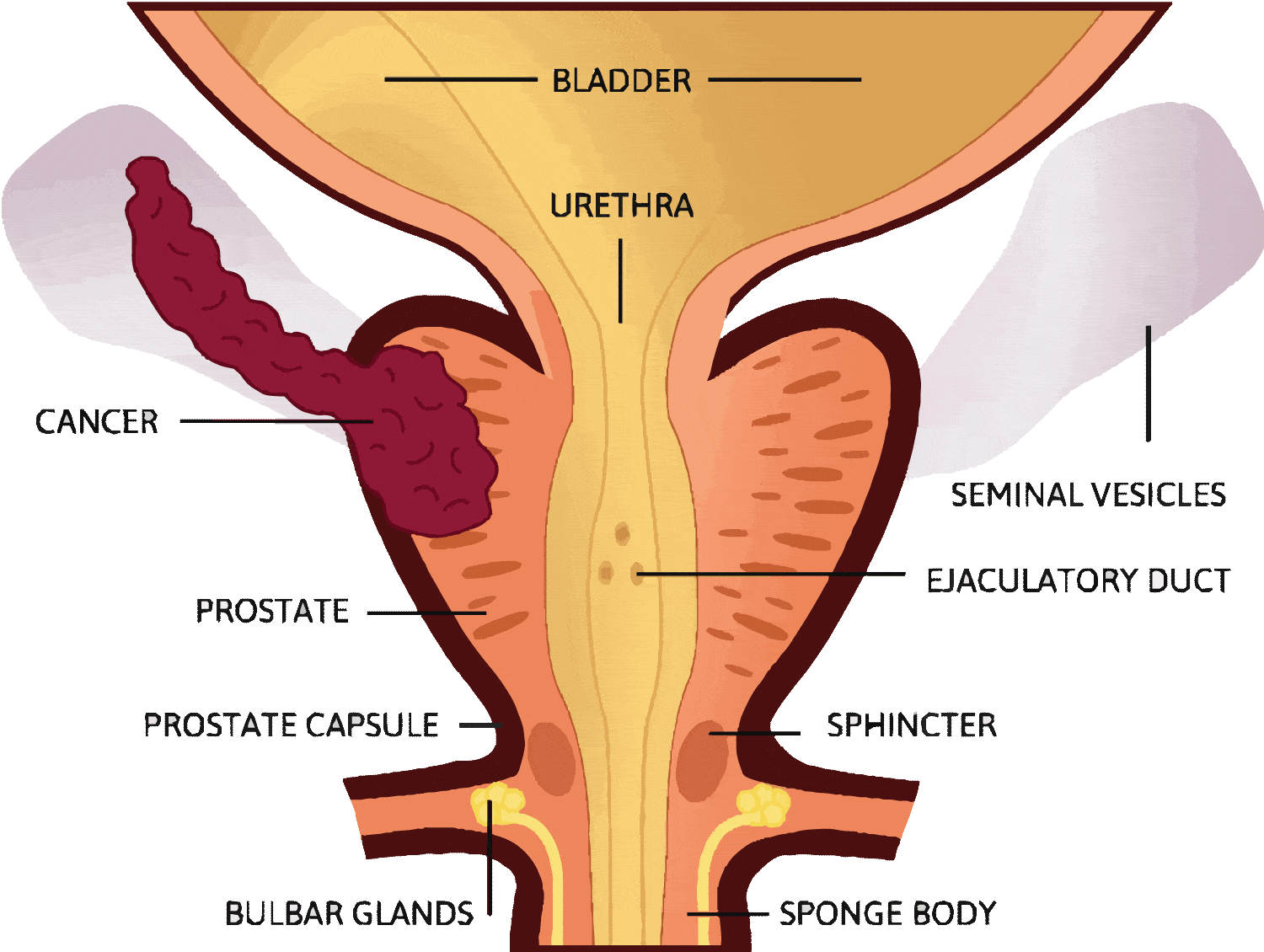 Location of prostate cancer near seminal vesicle