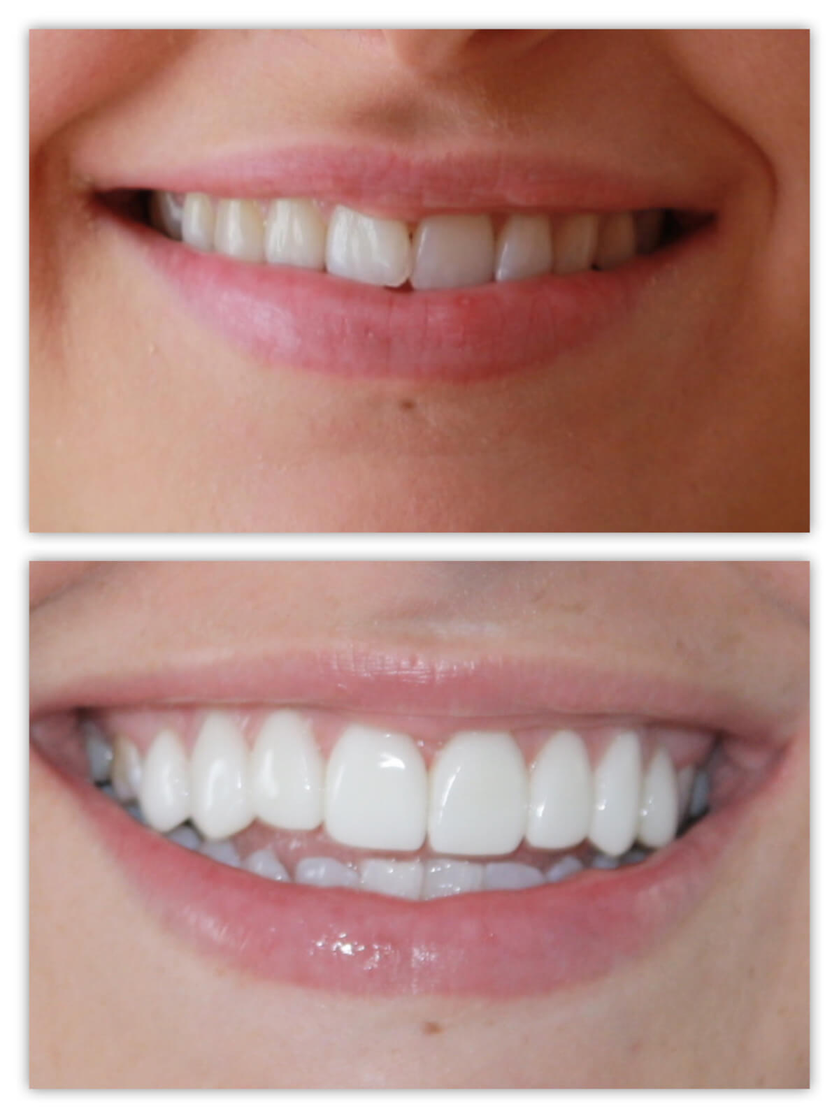 chiurgie esthetique www chirurgiestunisie com facette