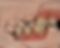 Removable Dentures.png