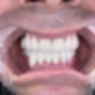 Patient's mouth with new bright digital dentures