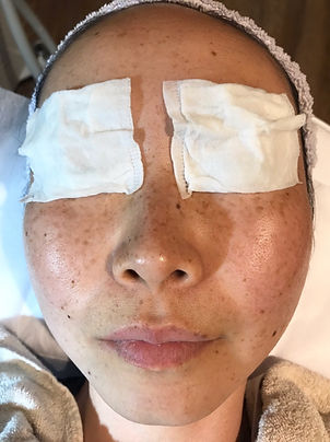 E light5回施術-1.jpg