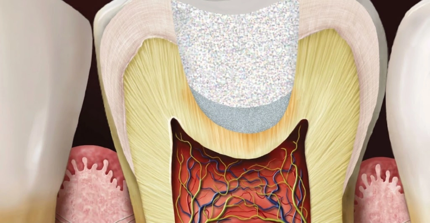 Vital Pulp Therapy Pulptis: Diagnosis & Case Selection | Dr