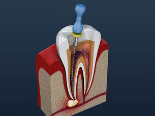 Root canal treatment
