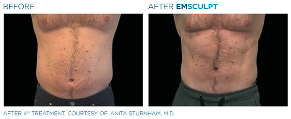 Emsculpt_PIC_Ba-card-male-abdomen-007_EN100.png