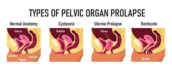 Types-of-Pelvic-Organ-Prolapse-1024x423.jpg