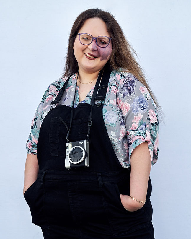 Crystal standing in black overalls with a camera around her neck. Has purple birthmark on her face.