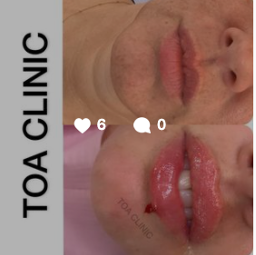 Lip Fillers by Sofia Maria Hayat