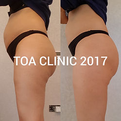 skin tightening