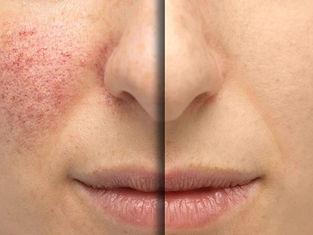 Calming Rosacea Facial