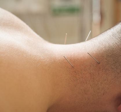 patient-getting-dry-needling-on-neck.jpg