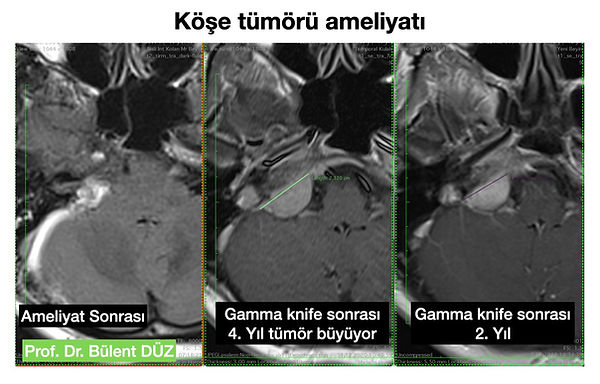 PCA tumor right- Prof Bulent Duz.jpg