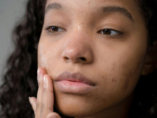 Pore clogging ingredients causing break outs and why a