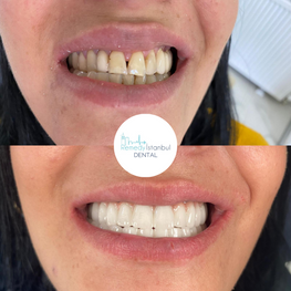 dental veneers before after