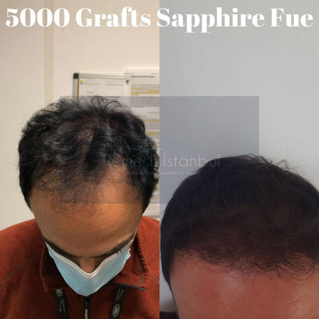 Greffe de cheveux avant après