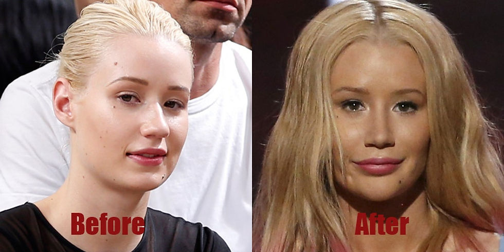 Iggy Azalea Before After