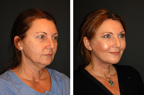 Deep Plane Face Lift