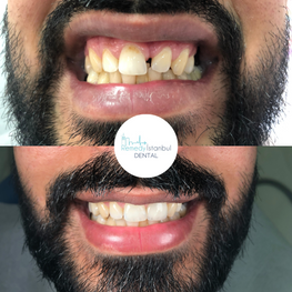 dental veneers before after