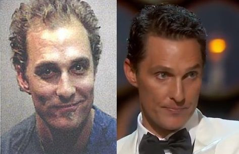 Matthew McConaughey Hair Transplant Before After