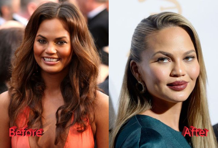 Chrissy Teigen Face Aesthetic Surgery