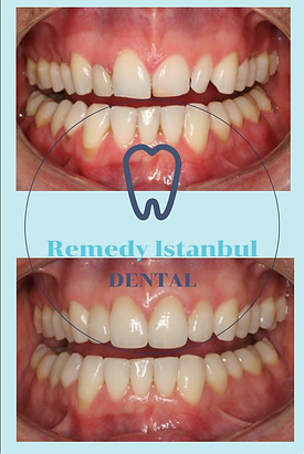 Veneers Before After 11