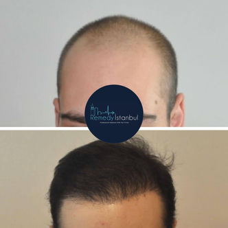 Greffe de cheveux avant après