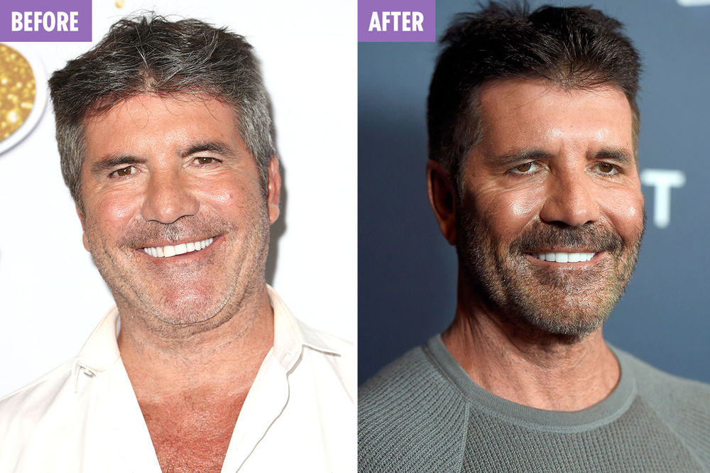 Simon Cowell Plastische Chirurgie