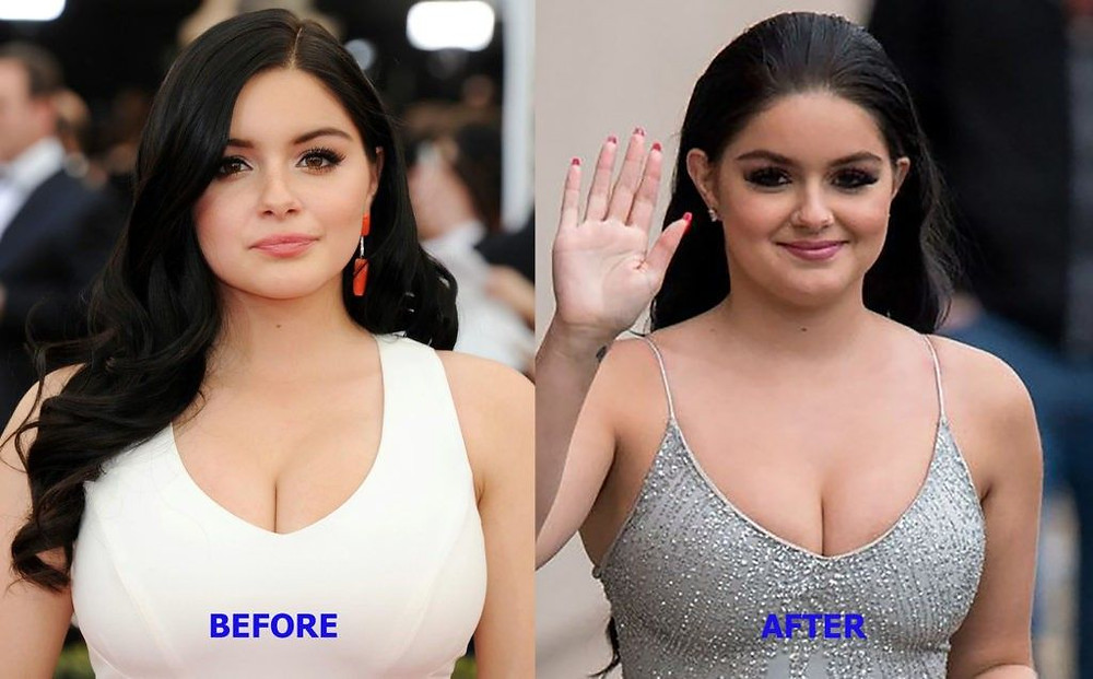 Ariel Winter plastic surgery before after