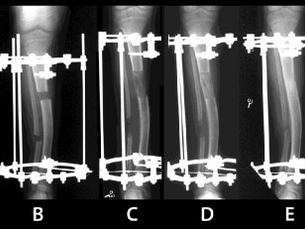 The Gradual Distraction Technique in Limb Lengthening