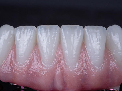 4 implantes fixo (sin abutment)