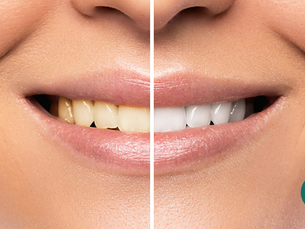 Receitas caseiras para clarear os dentes realmente funcionam e não são prejudiciais – MITO