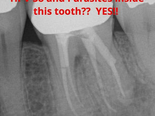 Can HPV and Parasites Hide in Your Dead Teeth?