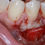 Thumbnail: Free Gingival Graft (FGG)