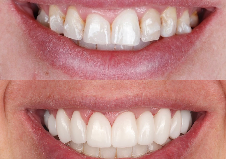 Dental Implants Smile Make Over.JPG