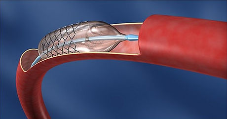 Angioplastia(1).jpg