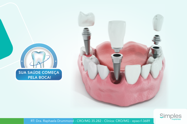 o-que-e-implante-dentario