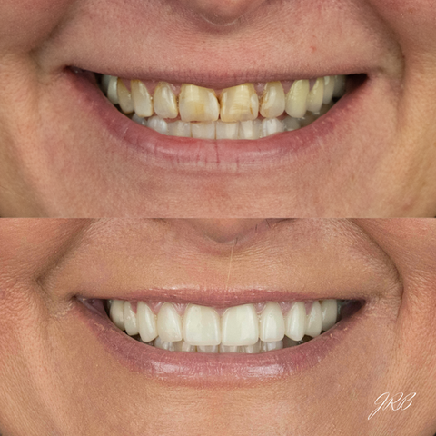 Crowns & Dental Implants