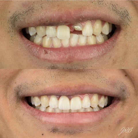 Ceramic Crowns