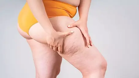 Foto de pernas com lipedema