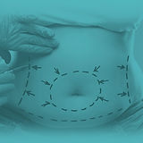 Abdominoplastia.jpg
