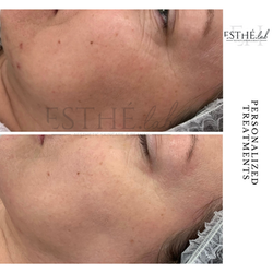Skin booster