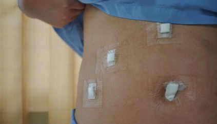 What to Expect from a Laparoscopic Cholecystectomy