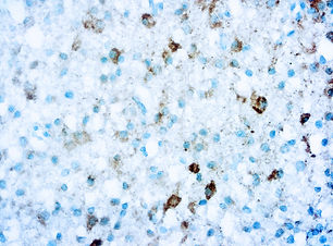 Isocitrate Dehydrogenenase 1 (IDH1)