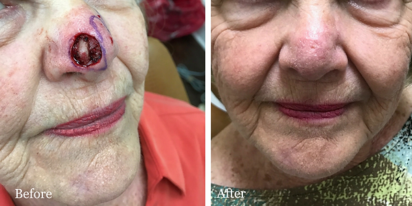 Before and After Mohs Reconstruction on female patient by Dr. Azzi in Palm City Florida