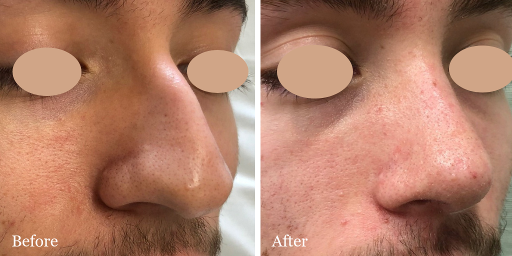 Male rhinoplasty by Dr. Azzi