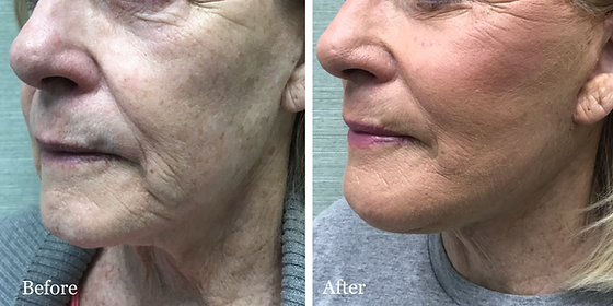 Revision Facelift Neck Lift Photo Gallery Dr Azzi Jupiter Stuart