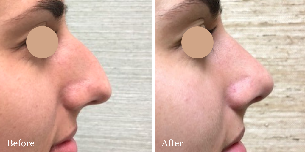 Female rhinoplasty by Dr. Azzi - profile view