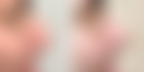 Female rhinoplasty by Dr. Azzi - profile view