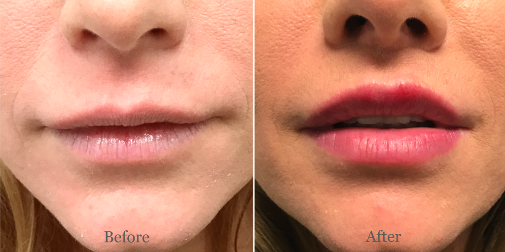 What is a Lip Lift?