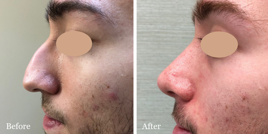 Male rhinoplasty by Dr. Azzi - profile view